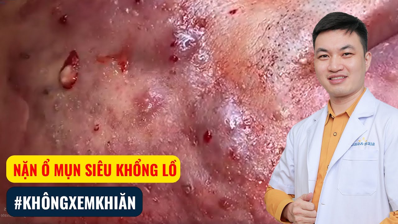 NẶN Ổ MỤN SIÊU KHỔNG LỒ #khôngxemkhiăn