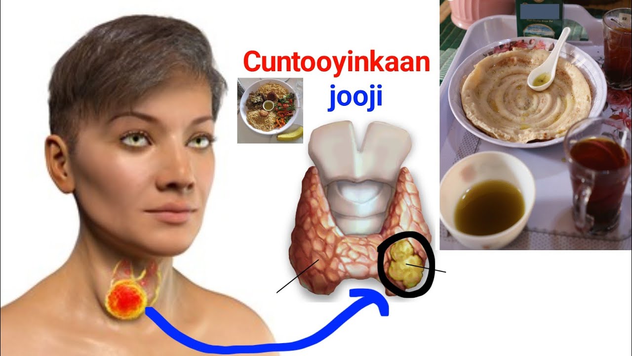 Kansarka dhuunta cuntooyinka somaalida ku sababa oo ka qeeyb ka qaata ka fogoow ❌