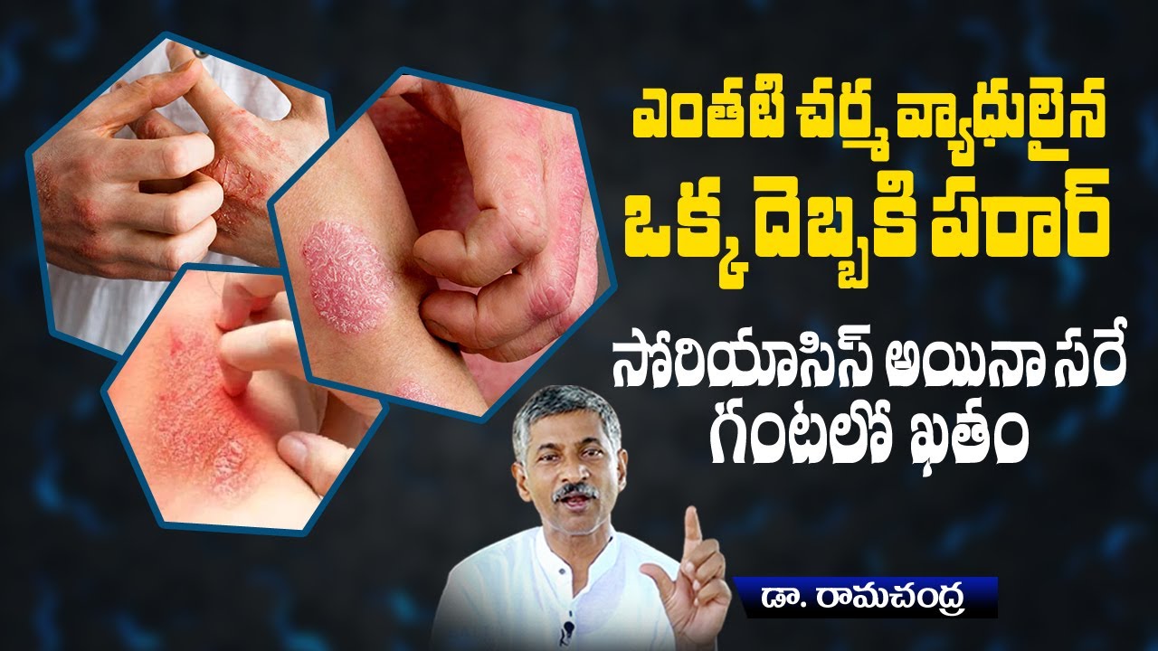 How To Cure Psoriasis Naturally At Home | Skin Inflections | Psoriasis Diet Plan | Dr Ramachandra