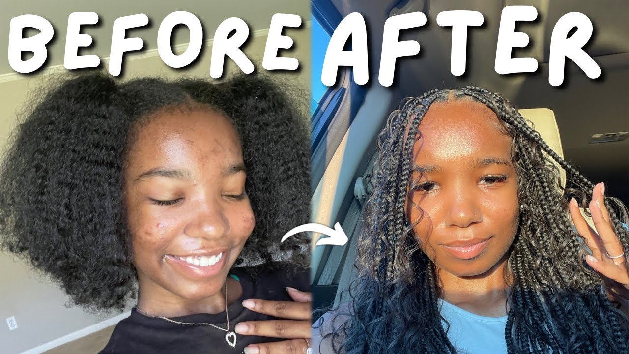 How I Cleared My Acne in 3 Months (These Products Changed My Skin ...
