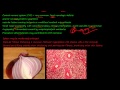 92P  Morphology of Systemic lupus erythematosus, SLE, part 3