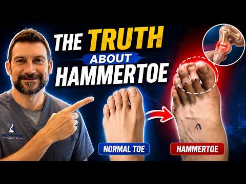 Hammer Toes Explained: What Causes Them, How to Treat Them, and When to Acto
