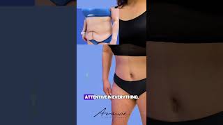 Before and After Abdominoplasty & Liposuction 360 | Avance Plastic Surgery Institute: Dr. Erez Dayan