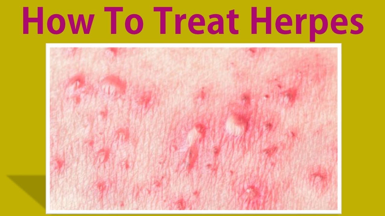How To Treat Herpes -Get Rid Herpes With These Effective Natural Home