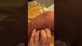 Dry Needling Tennis Elbow: Motor Points of Forearm Extensor/Suppinator