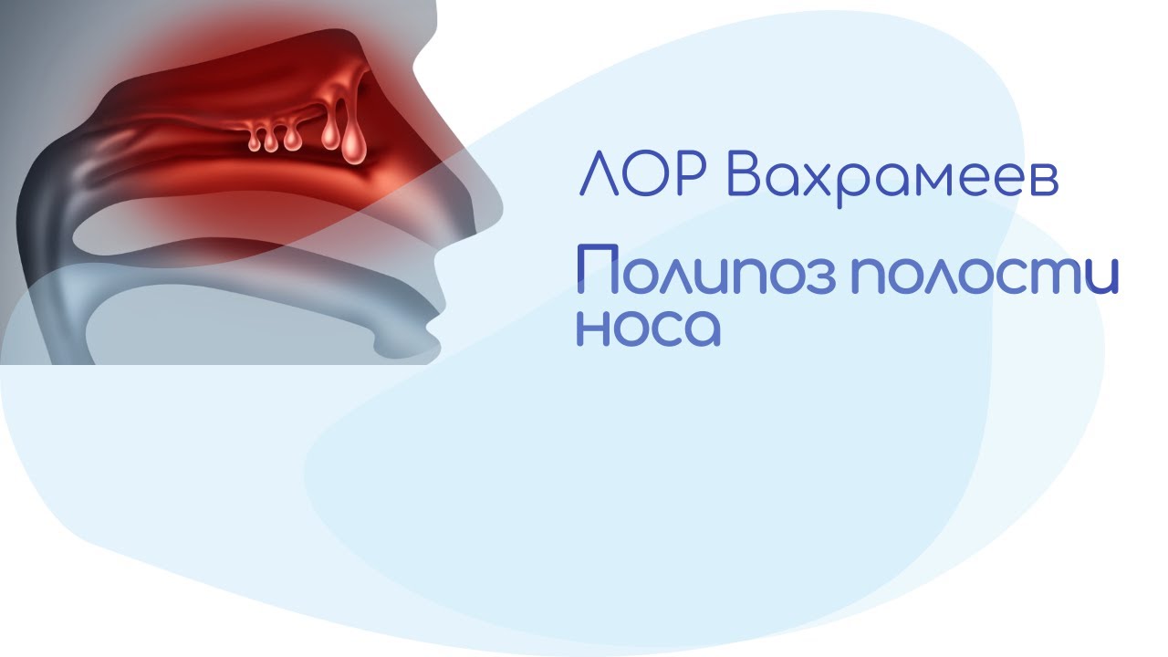 Полипоз полости носа-Еще не рак, но стоит насторожиться. Чем опасен полип в носу?
