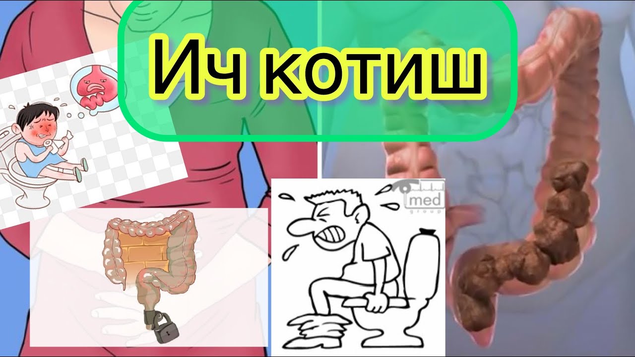 Ич котиш- ичнинг уз вактида келмаслиги йоки келишинг кийинлиги. Сабаблари, даволаш усуллари