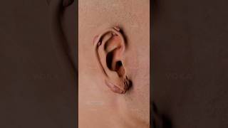 How keloid scars appear: the impact of piercings visualized in 3D