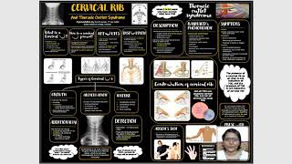Cervical Rib And Thoracic Outlet Syndrome - Eposter Presentation
