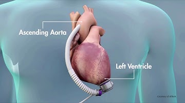 Treating Heart Failure with the Heartmate 3 LVAD