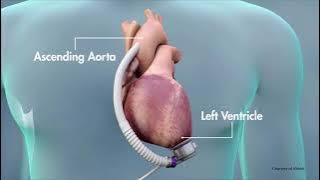 Treating Heart Failure with the Heartmate 3 LVAD