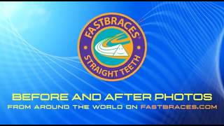 Multiple orthodontic treatments in days using Fastbraces Technologies