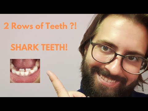 My kid’s tooth is growing behind his baby teeth ?! Shark teeth!