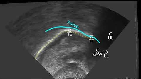 RealTongue: motion-compensated ultrasound video of tongue movements