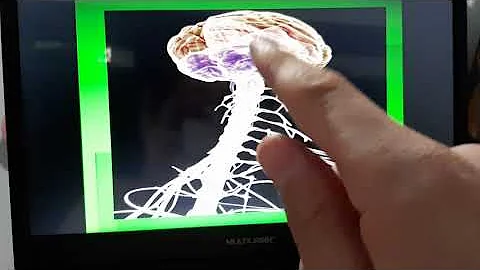 O que significa compressão medular?