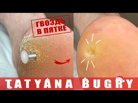 35 YEAR OLD CALLOUS 😱 Removing Callouses & Super Deep Corns PART 2 #TatyanaBugry