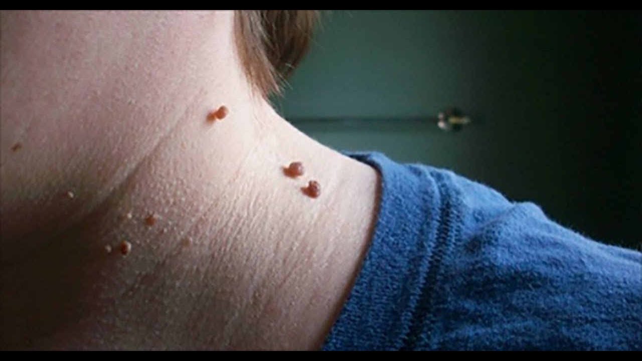 7 Easy Ways To Remove Skin Tags Without Seeing A Doctor Youtube