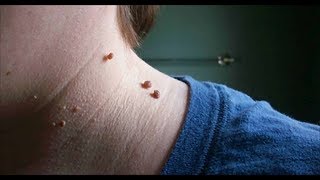7 Easy Ways to Remove Skin Tags Without Seeing a Doctor