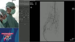 Stern D2 - Live Case - Calcified BTK CTOs Left, CLI - Leipzig, Germany