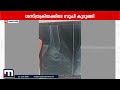 ശസ്ത്രക്രിയ്ക്ക് ശേഷം മുറിവിനുള്ളില്‍ കുടുങ്ങിയ  സൂചി സ്വയം പുറത്തെടുത്തെന്ന് പരാതി