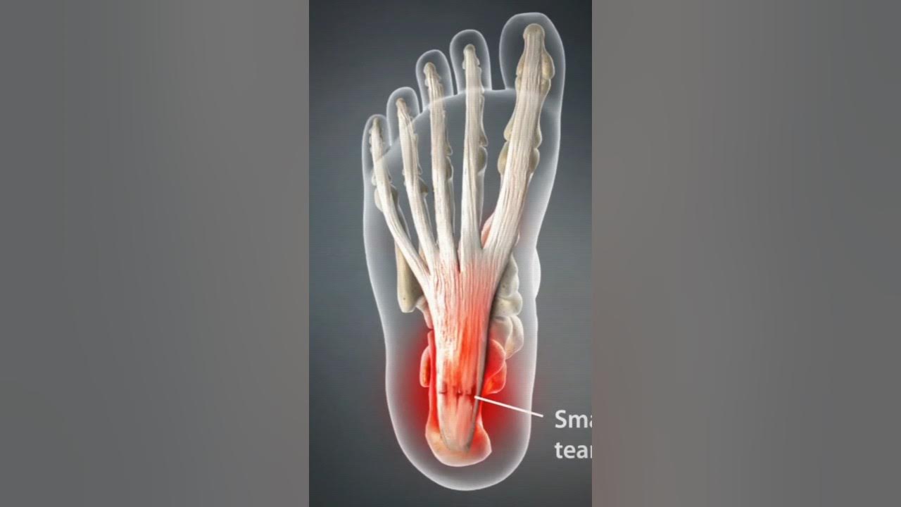 Top 2 Exercises for Plantar Fasciitis Relief. plantarfasciitis 