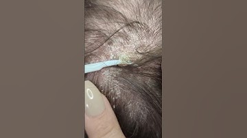 Satisfying LARGE Flake Removed with Pick #psoriasis #flakes #scalpscratching