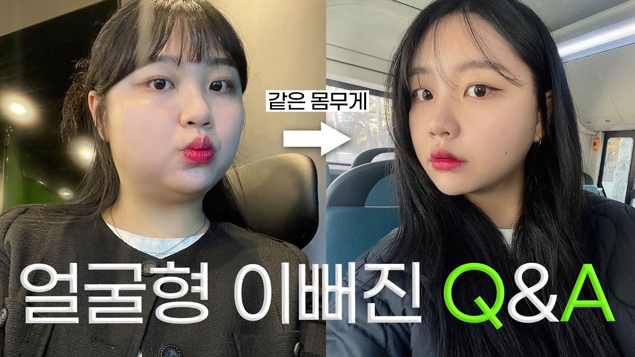 턱살부자에서 턱살거지 된 썰ㅣ 성형브이로그 2편ㅣ뷰티라인성형외과 - YouTube