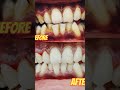 Scaling ka Amazing Result 🔥”#dentist #trendingnow #viralvideo