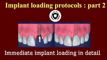 Implant Loading Protocols : Part 2
