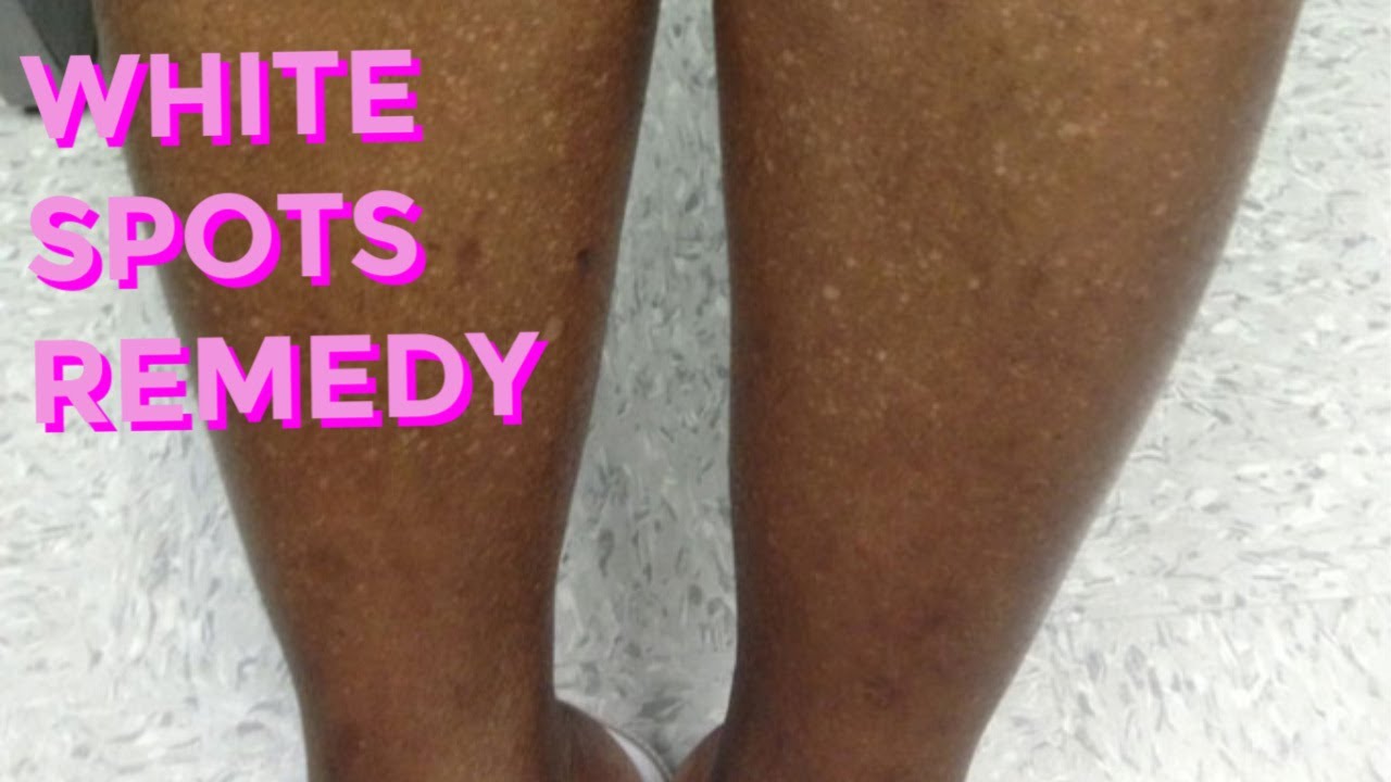 How To Get Rid Of White Spotsdots Caused By Skin Lightening Creams