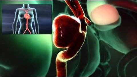 Endovascular Treatment for Cerebral Aneurysms