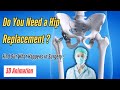 Total Hip Replacement Surgery Explained | THR Procedure, Recovery & Anatomy of Hip Joint