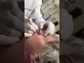 Office Repair Nasal Valve Collapse