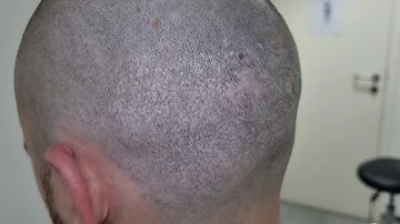 1st session FUE Hair Transplant Camouflage Best SMP in London Scalp Micropigmentation by El Truchan