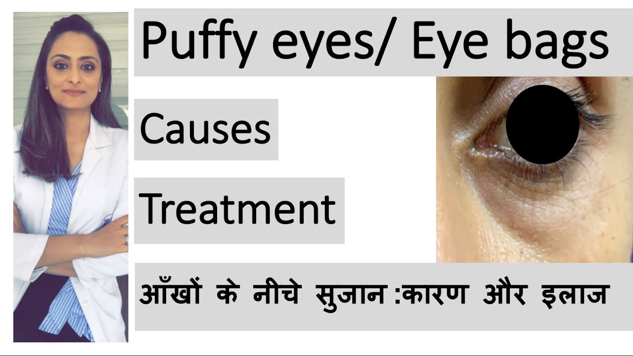 puffy eyes eye bags aankhon ke neeche sujan कारण और इलाज Dr