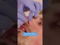 nose hairs  can be easily removed with sugar wax #bodywax #waxy #hairremoval #waxing #skincare