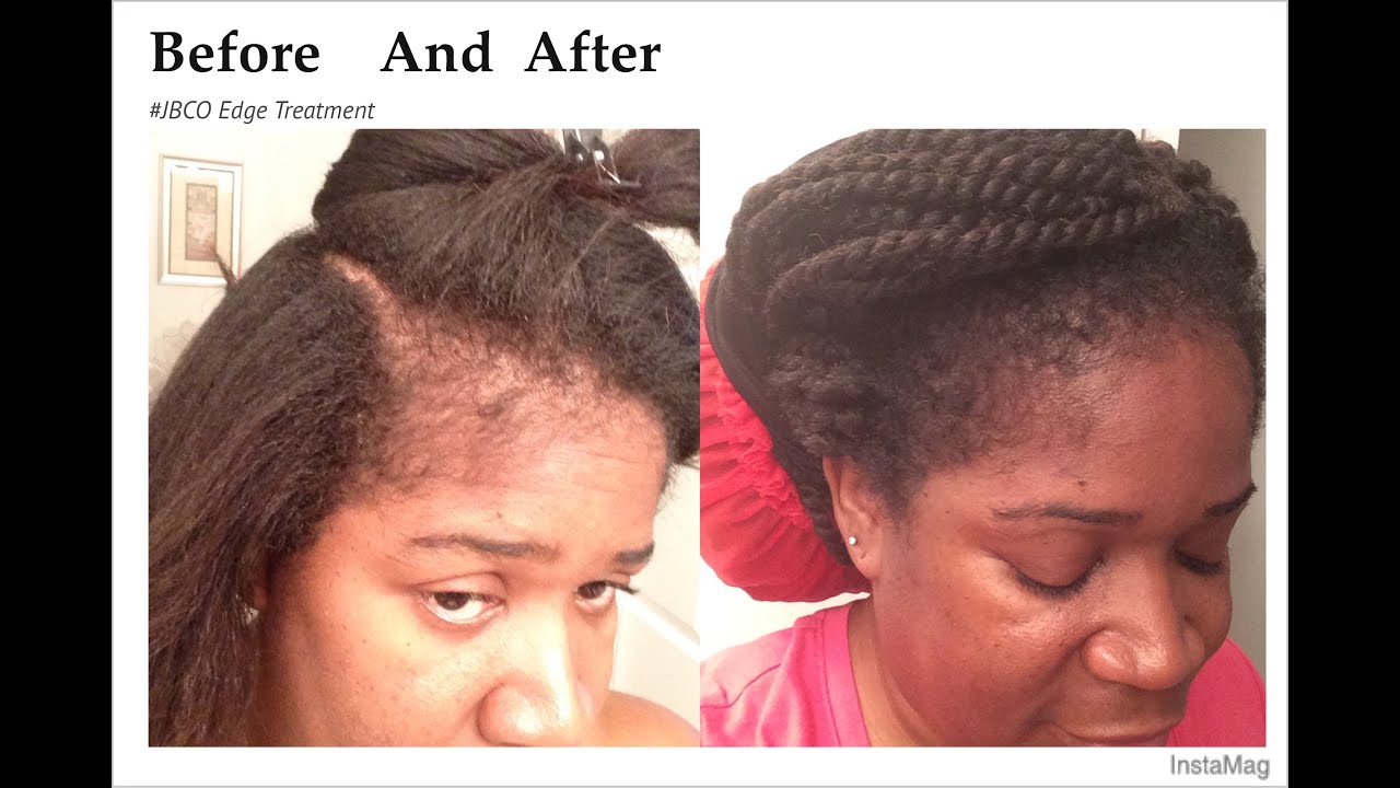 Jamaican Black Castor Oil EDGE TREATMENT How To Safely ReGrow