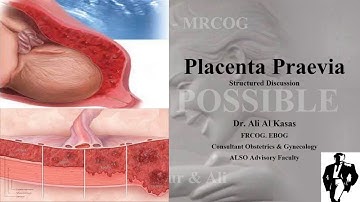 Placenta Praevia -  SD Task -  MRCOG Part 3 Mission Possible Course Guide Session Part 3