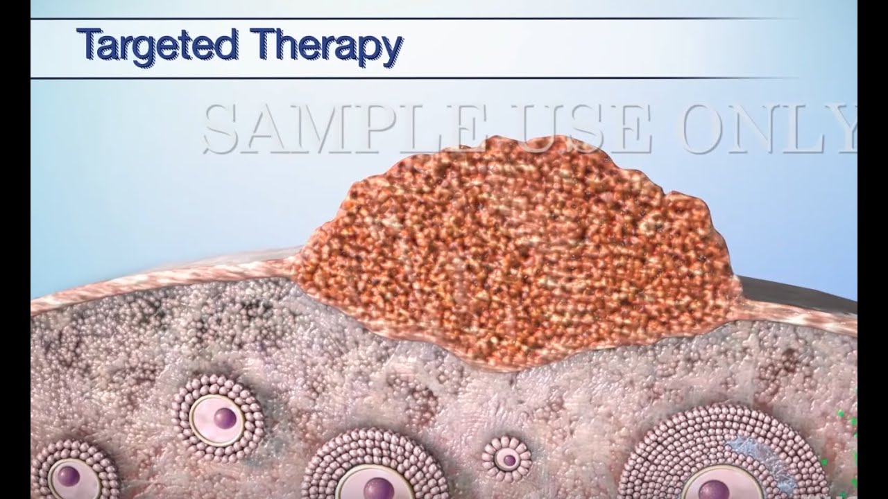 Treatment Options for Ovarian Cancer