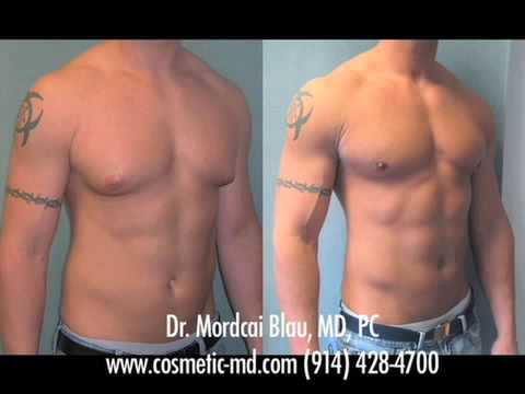 gynecomastia surgery cost magdalene project org gynecomastia surgery cost