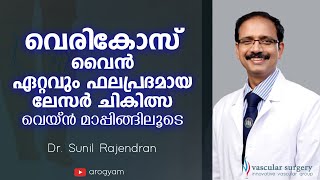 വെരികോസ് വെയ്ൻ ഏറ്റവും ഫലപ്രദമായ ചികിത്സ | Varicose veins Treatment in Malayalam| Dr Sunil Rajendran
