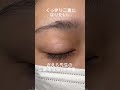二重整形のビフォーアフター