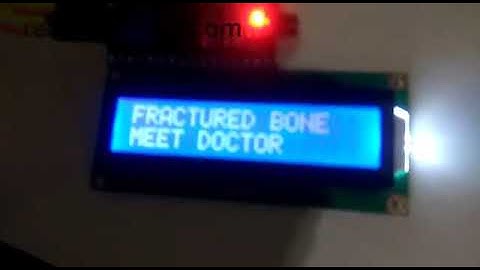 Bone Fructure Detection Using Matlab SVM image processing Artificial Intelligence Machine Learning R