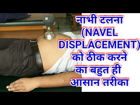 Navel Displacement Treatment/Navel Displacement Cure/Nabhi Talna/Navel
