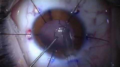 Sinsky and Iris Hook Assist