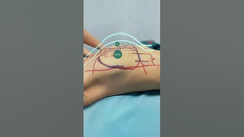 Cận cảnh quá trình nâng ngực tại viện thẩm mỹ Elia