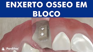 Enxerto osseo em bloco ©