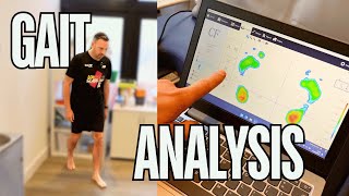 My gait analysis was shocking!!