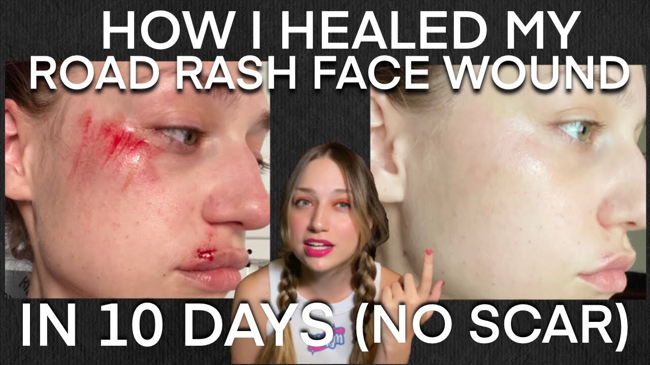How To Stop Your Wound From Scarring my Facial Road Rash Quick Healing How To Stop Your Wound From Scarring my Facial Road Rash Quick Healing
