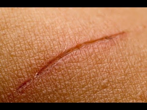 Video: 3 manieren om olijfolie te gebruiken om littekens te verwijderen